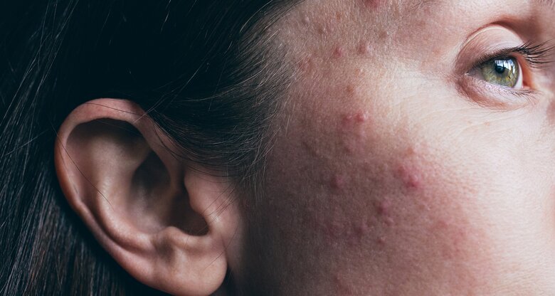 Eine Frau hat Unreinheiten im Gesicht | © GettyImages/Jena Ardell