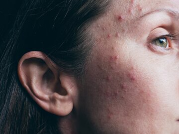 Eine Frau hat Unreinheiten im Gesicht | © GettyImages/Jena Ardell