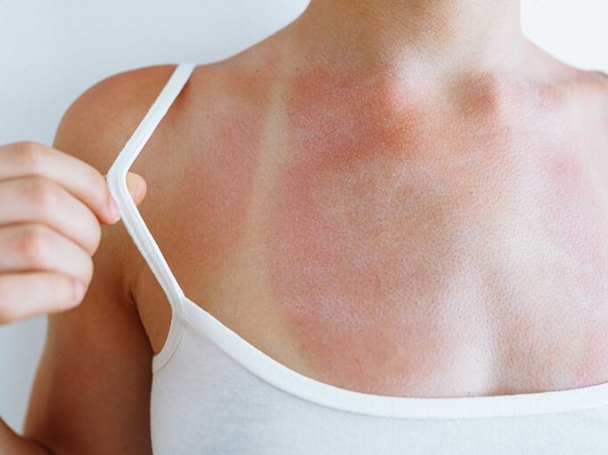 Dekolleté einer Frau, die einen Sonnenbrand hat | © Getty Images/Larisa Stefanuyk