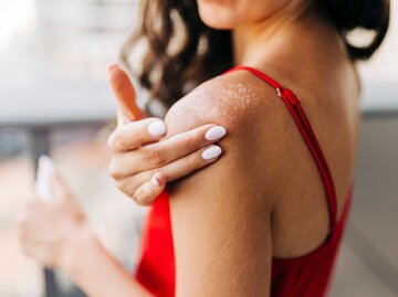 Frau cremt sich sonnenverbrannte Haut ein | © Getty Images/Eleganza