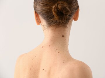 Junge Frau mit vielen Muttermalen am Rücken - von hinten fotografiert | © Adobe Stock/Pixel-Shot