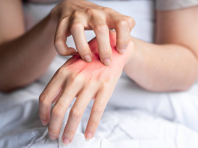 Frau hat juckenden Mückenstich an der Hand | © Getty Images/iStock