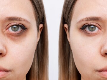 Eine junge Frau hat dunkle Augenringe wegen einem Wimpernserum | © GettyImages/Marina Demeshko