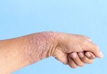 Hand mit Neurodermitis | © iStock.com / Sinhyu