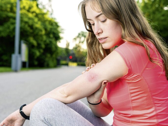 Frau sitzt am Straßenrand und hält ihren Arm mit einem Bremsenstich. | © iStock.com / Jens Rother