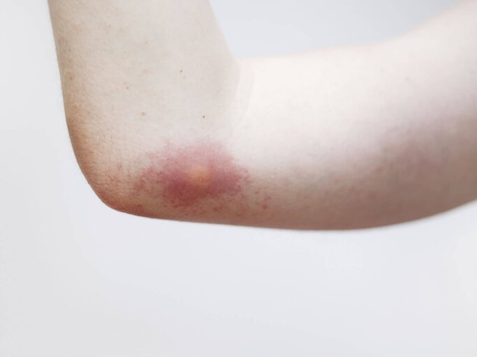 Ein Arm mit einem Wespenstich. | © iStock.com / borchee