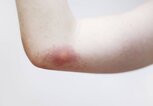 Ein Arm mit einem Wespenstich. | © iStock.com / borchee