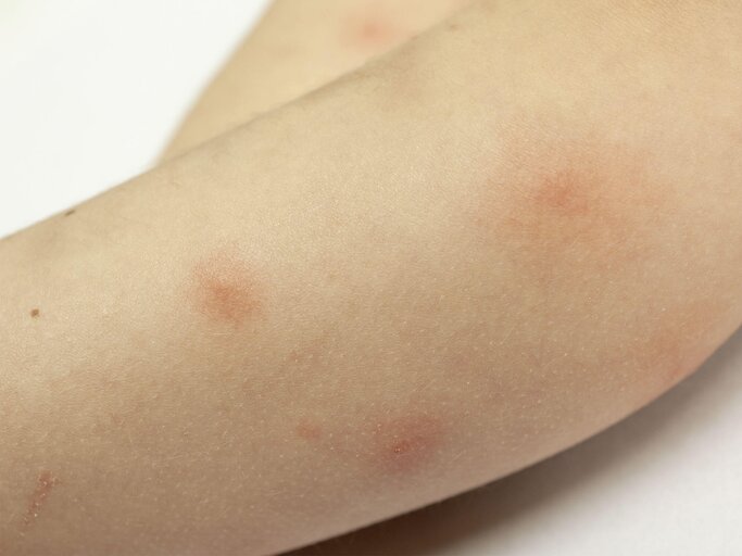 Arm mit mehreren Mückenstichen | © iStock.com / russaquarius