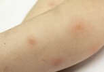 Arm mit mehreren Mückenstichen | © iStock.com / russaquarius
